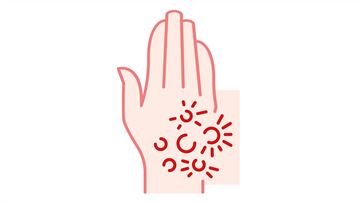 Beyond itching: Tackling Chronic Kidney Disease-associated Pruritus